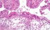 Micrograph of a mucinous ovarian tumor (Photo National Institutes of Health)